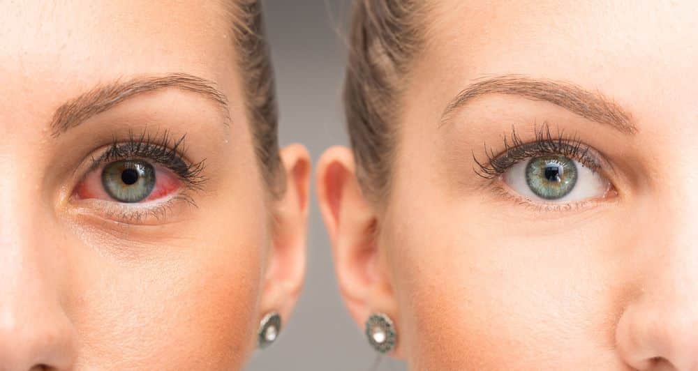 diferencia-entre-conjuntivitis-virica-y-bacteriana.jpg