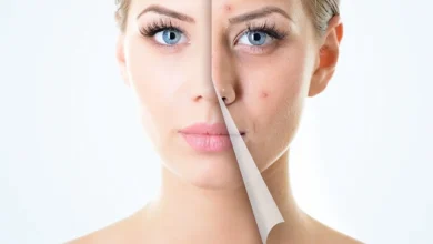 علاج حب الشباب