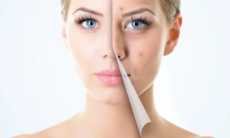 علاج حب الشباب