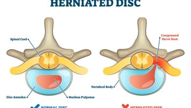 أعراض الانزلاق الغضروفي وعلاجه
