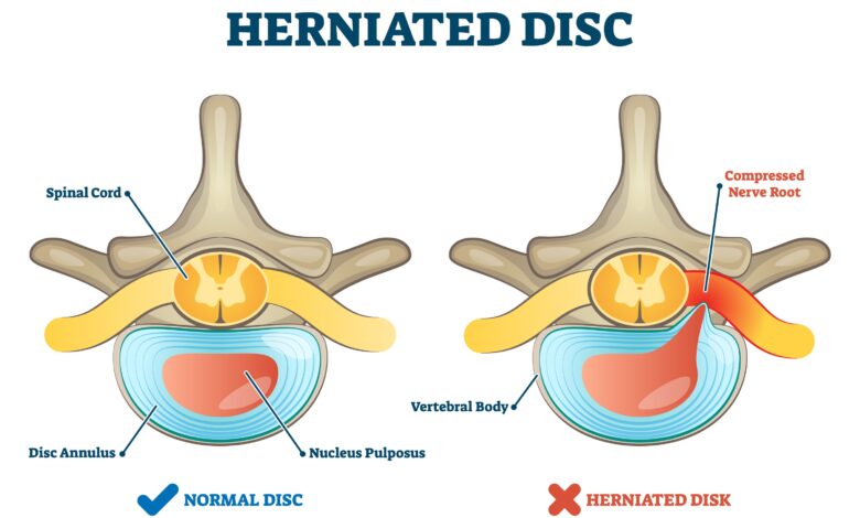 أعراض الانزلاق الغضروفي وعلاجه
