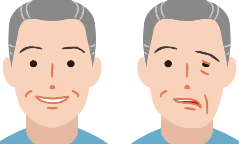 أعراض وعلاج العصب السابع